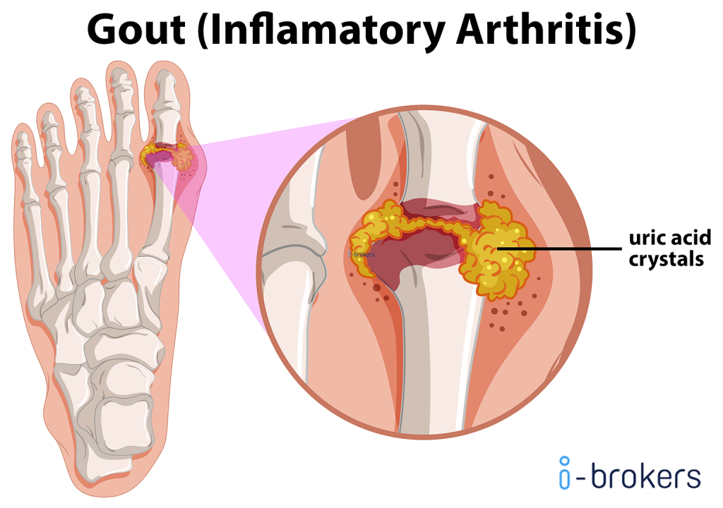 how to prevent gout on ankle